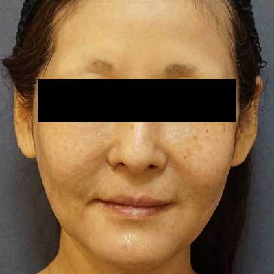 After image