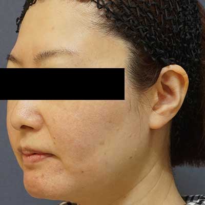 Before image