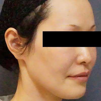 After image