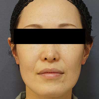 Before image
