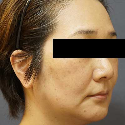After image