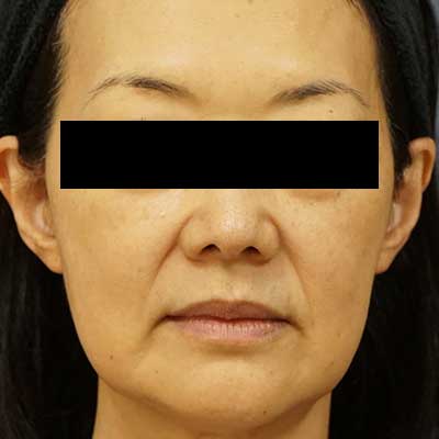 Before image