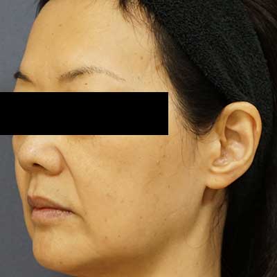 Before image