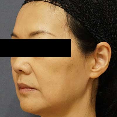 After image