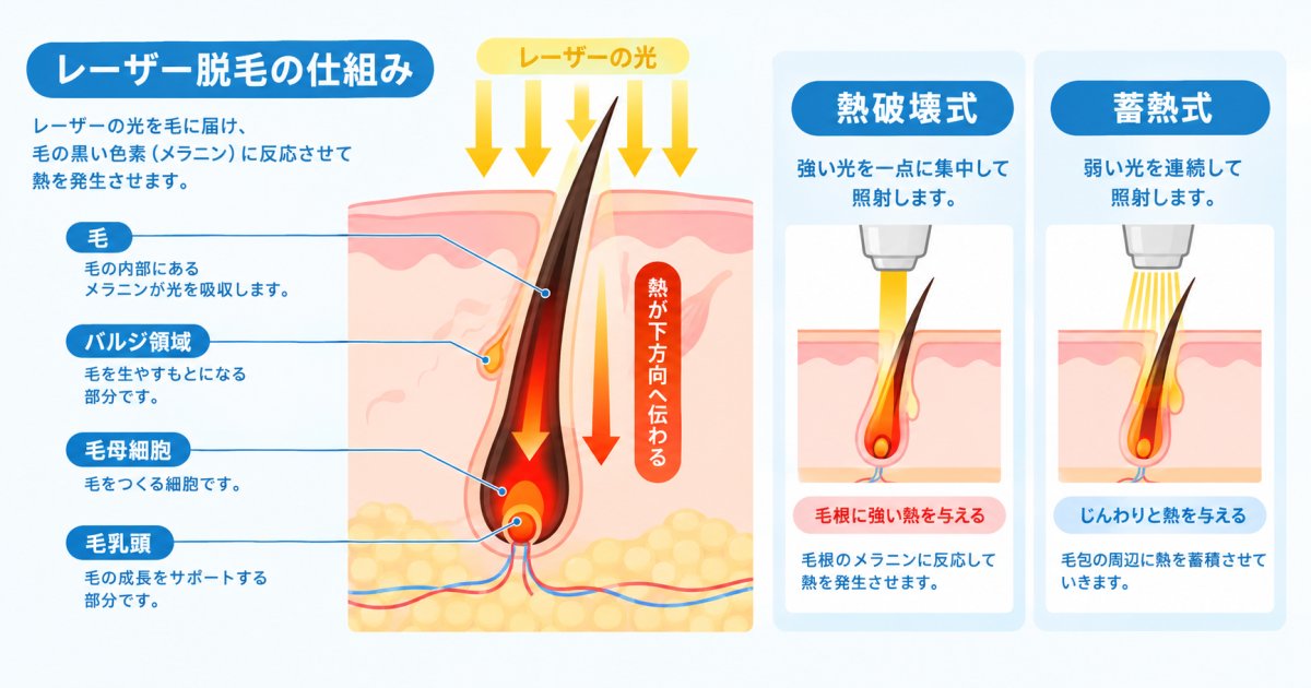 メンズ医療脱毛の仕組み—レーザーが毛根に働きかける原理